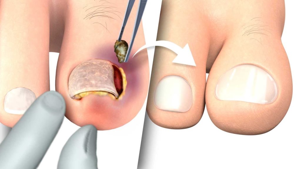 ingrown toenail removal